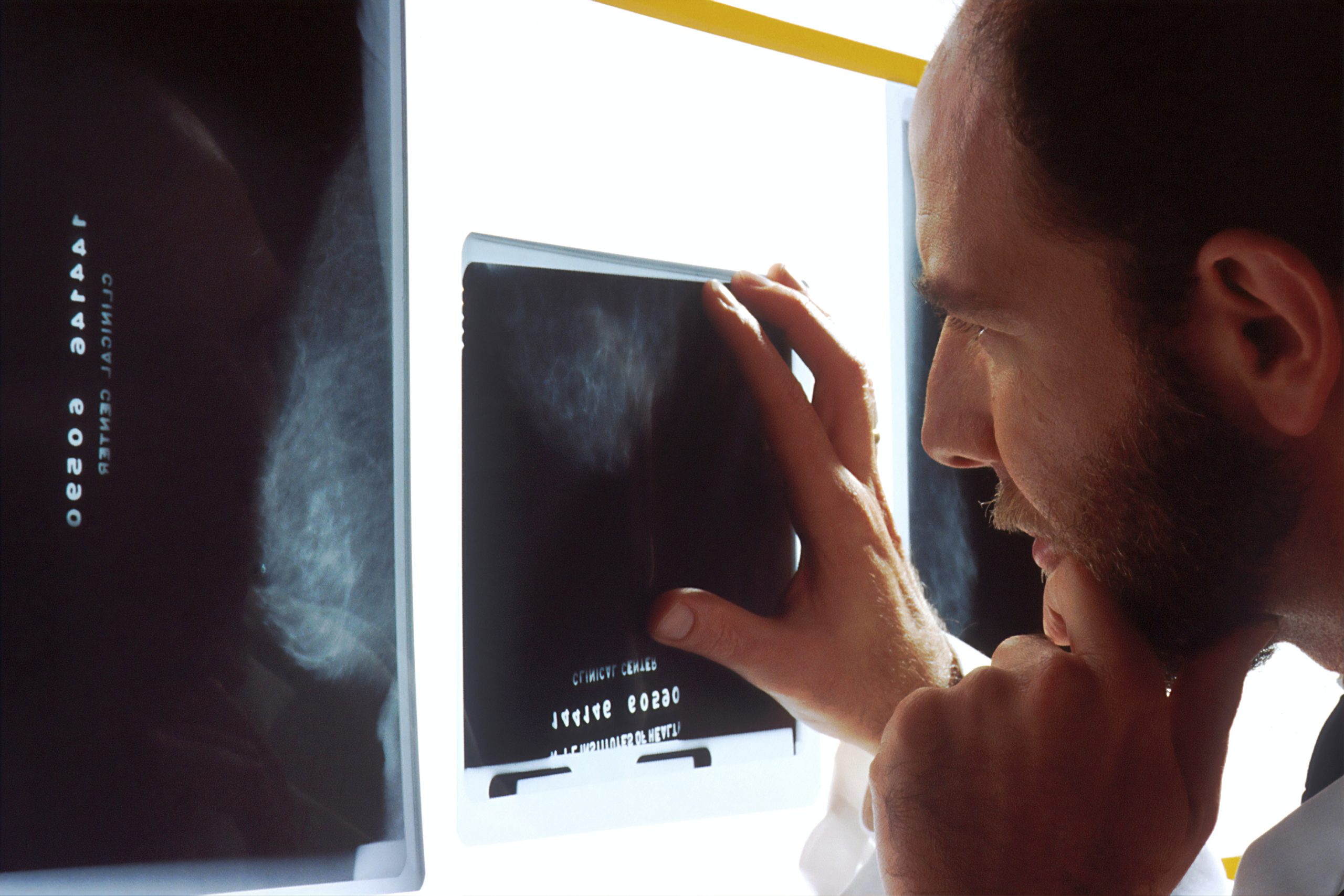 A doctor examines mammograms on a view box.